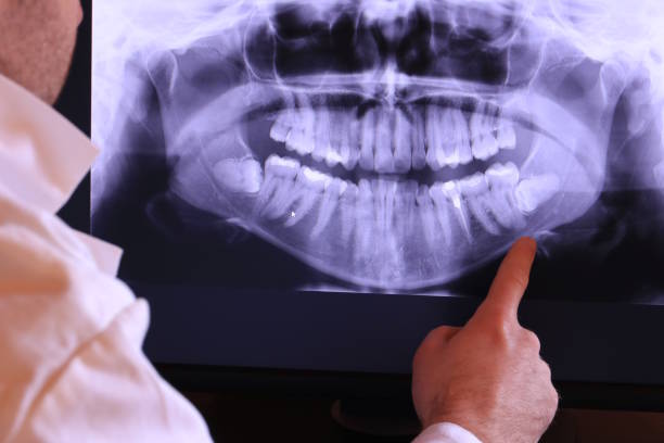 Best Knocked-Out Tooth (Avulsed Tooth) Treatment in Noblesville, IN